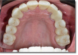 ST+Color Precolored Zirconia Block Sirona System  5 Pieces