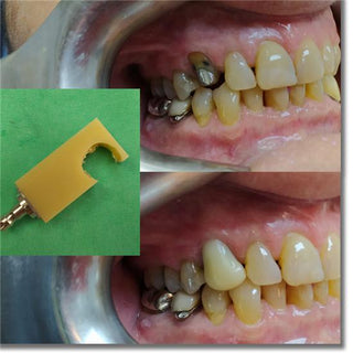 Sistema de circonitas monocromáticas de PMMA de 95 mm